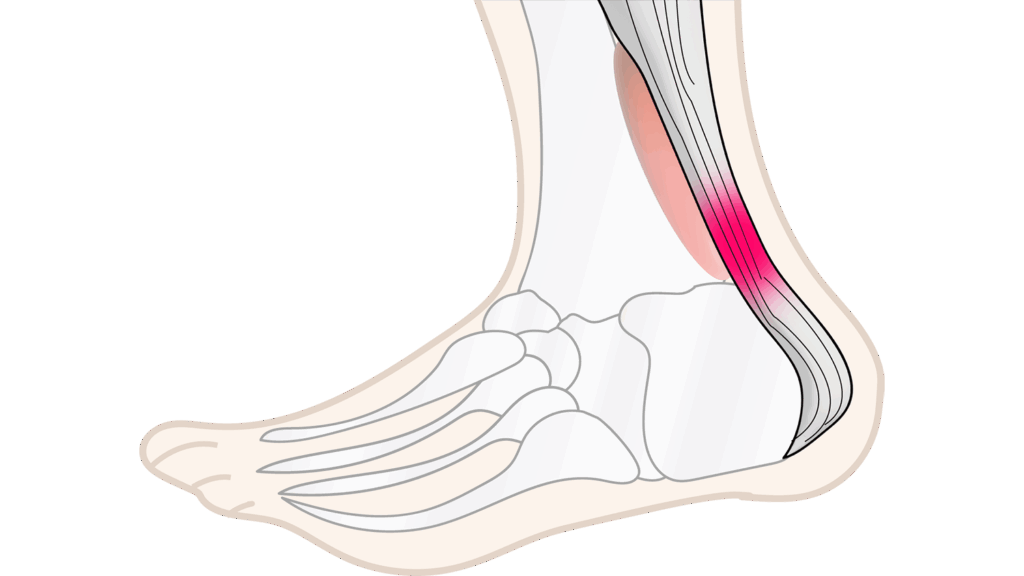 大田区アキレス腱炎治療