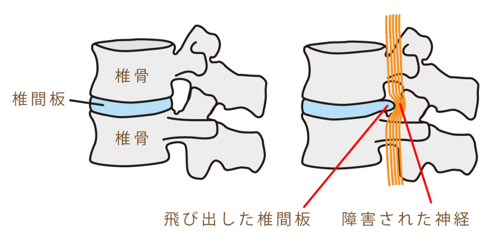 大田区腰椎椎間板ヘルニア整体