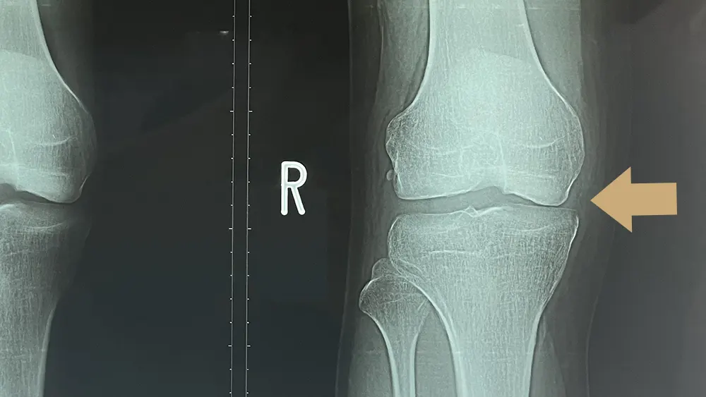 大田区膝の痛み外来