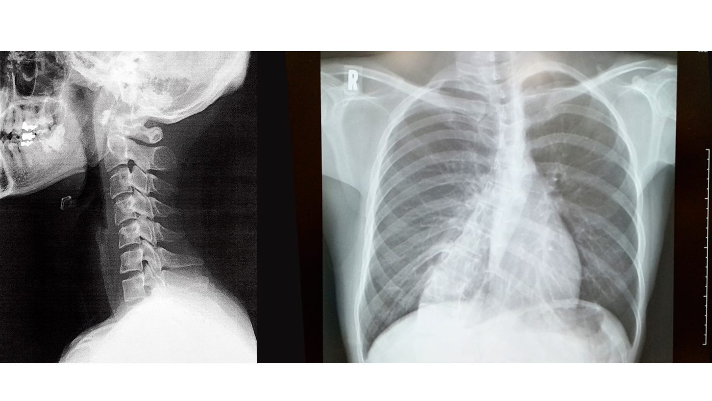 大田区筋膜リリース