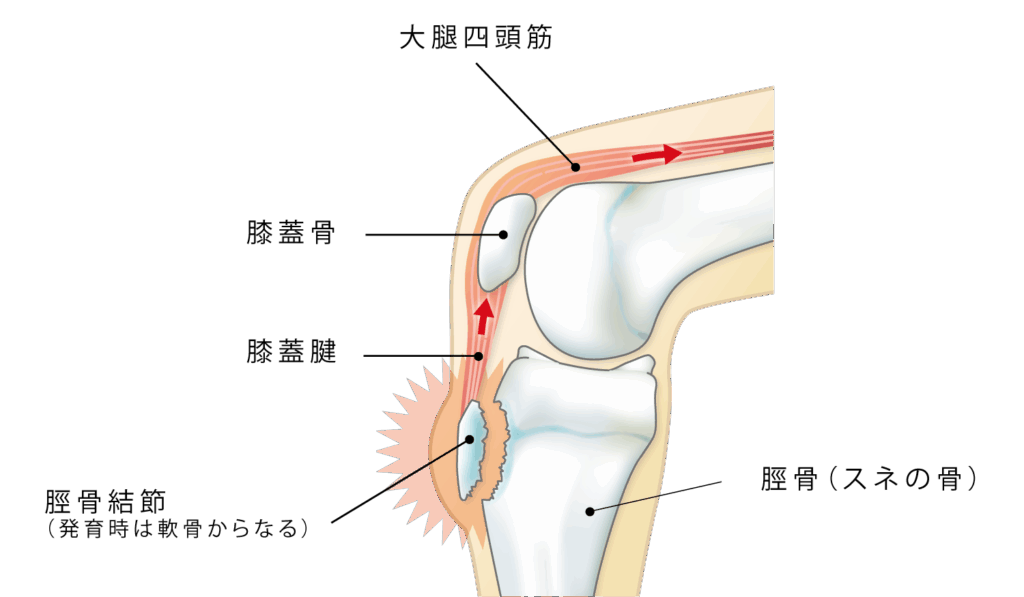 大田区オスグッド病治療