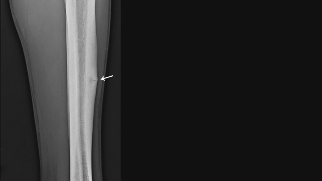 大田区シンスプリント治療