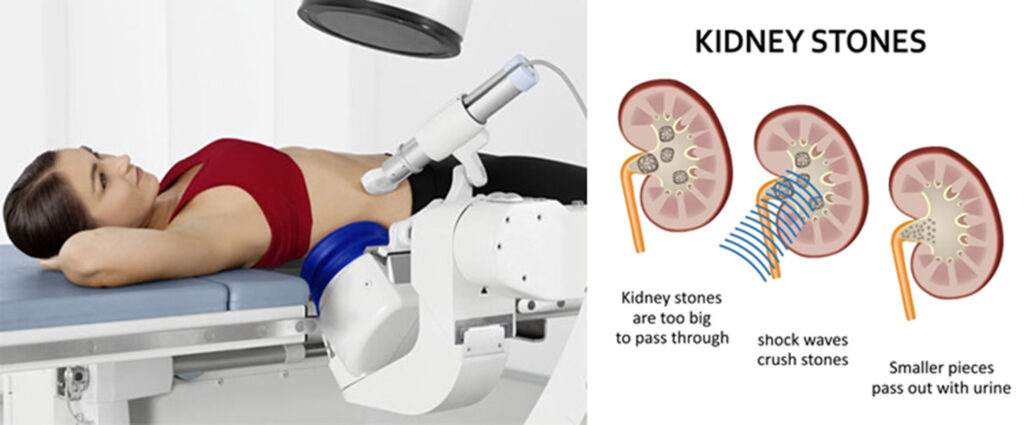腎結石で使用する衝撃波治療