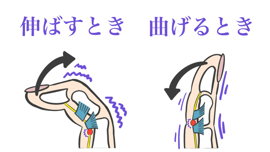 大田区ばね指治療
