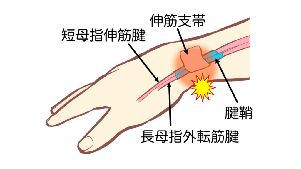 大田区腱鞘炎治療